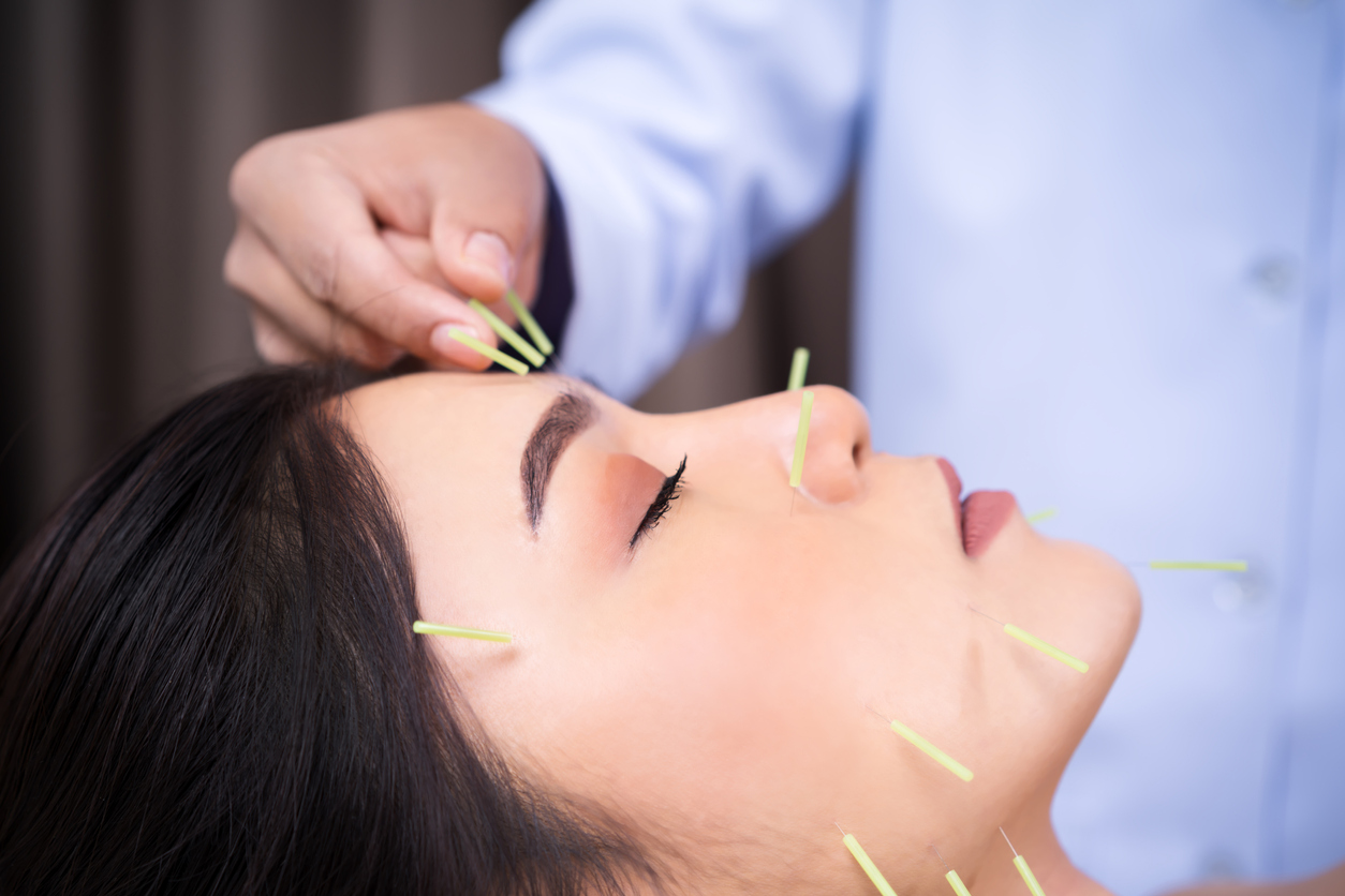 young woman undergoing acupuncture treatment on face