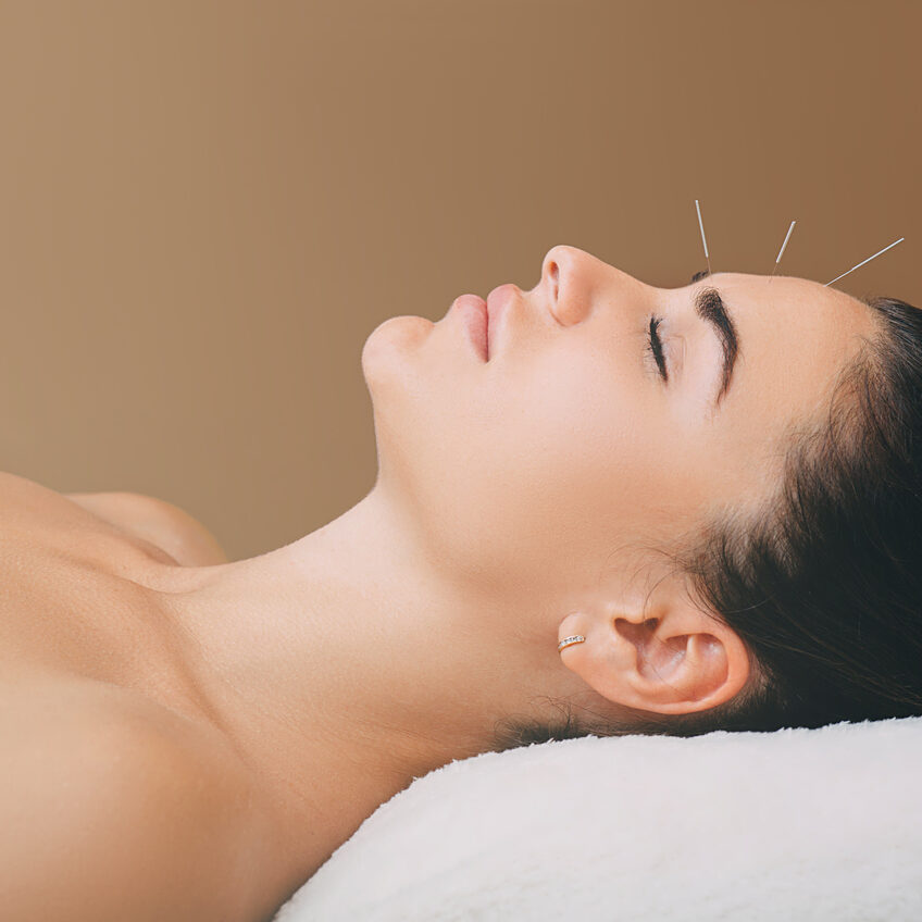 beautiful woman has a headache. Acupuncture treatment for migraines. Needles in the forehead of a woman close-up on a brown background